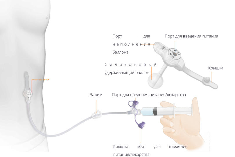 Порт для введения питания Порт для наполнения баллона Силиконовый удерживающий баллон Крышка Порт для введения питания/лекарства Зажим Крышка порт для введения питания/лекарства
