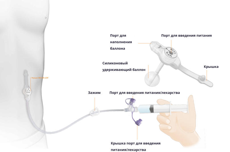 Порт для введения питания Порт для наполнения баллона Силиконовый удерживающий баллон Крышка Порт для введения питания/лекарства Зажим Крышка порт для введения питания/лекарства